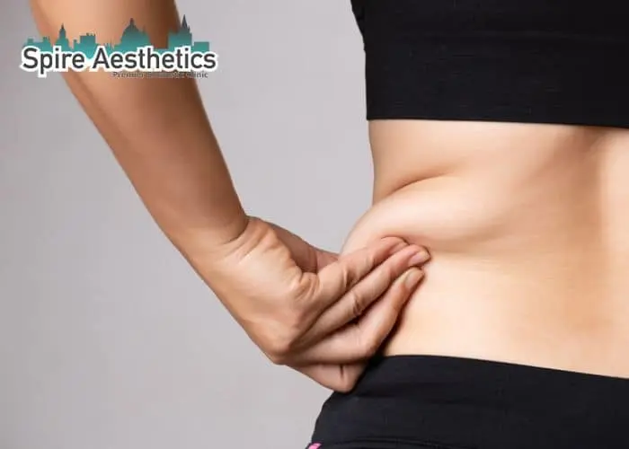 Image of woman pinching fat on their hips Bordesley. Fat Freezing treatment