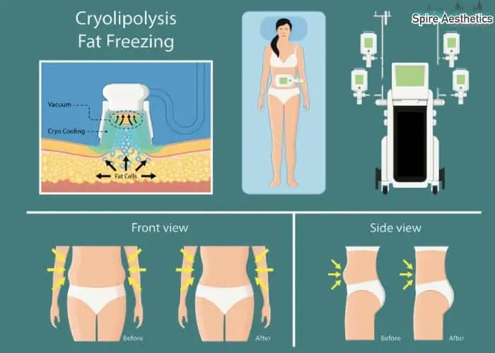 Fat freezing treatment Bordesley benefits for competitions to remove stubborn fat deposits.