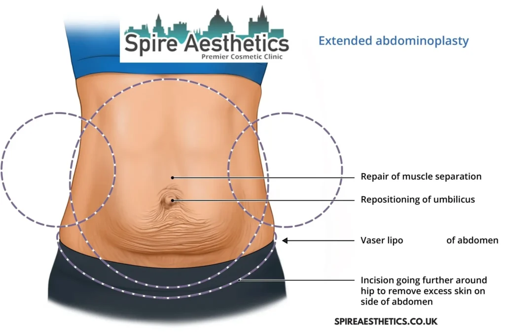 Understanding Loose Skin After Gastric Band Bordesley Surgery and HIFU Treatment