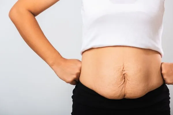 Image of a woman's stomach after weight loss with sagging skin following a gastric band Bordesley